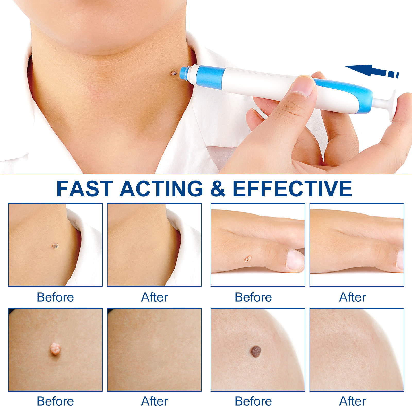 2-IN-1 Auto Skin Tag Removal K - Home Improvement Kit ulasan dan harga