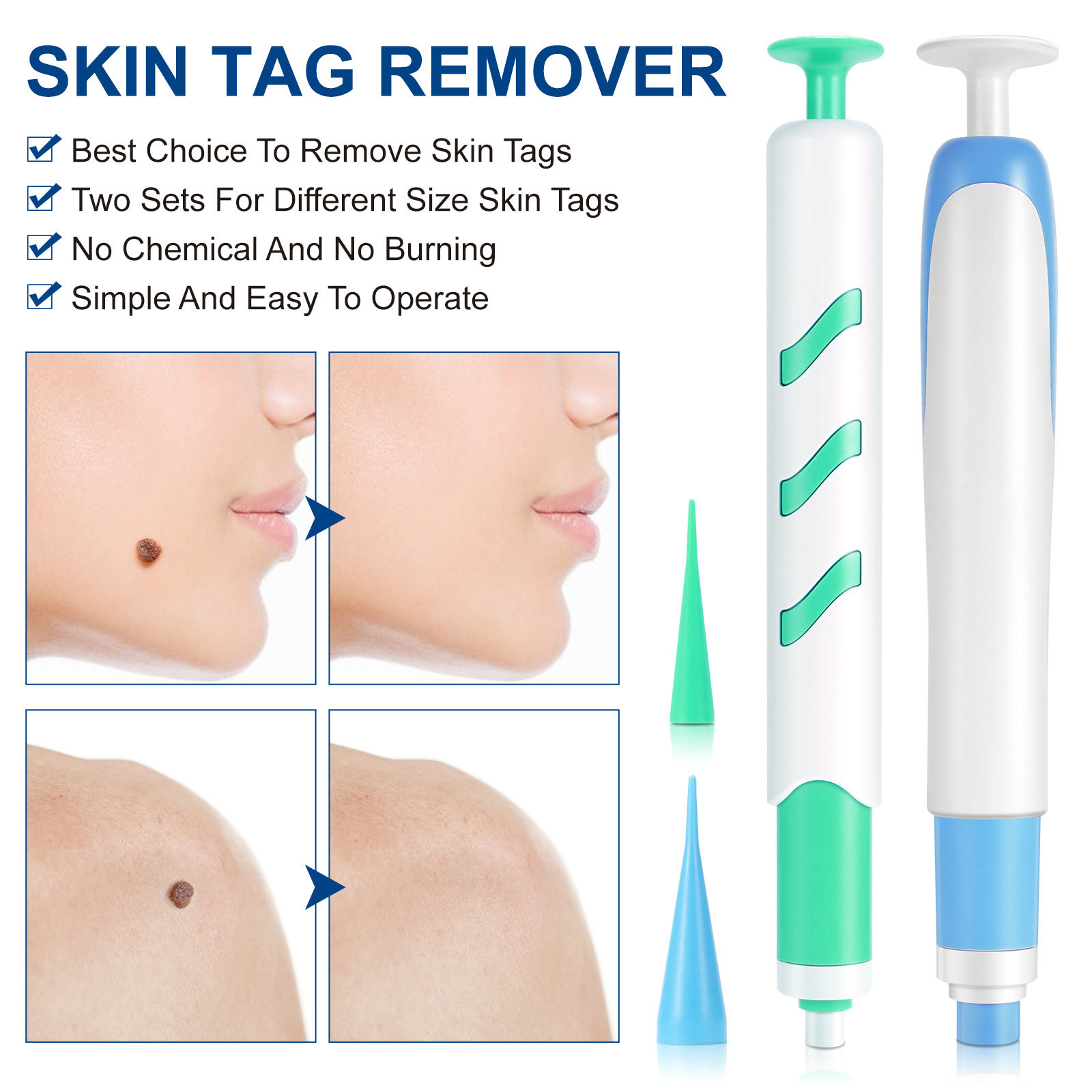 2-IN-1 Auto Skin Tag Removal K - Home Improvement Kit ulasan dan harga