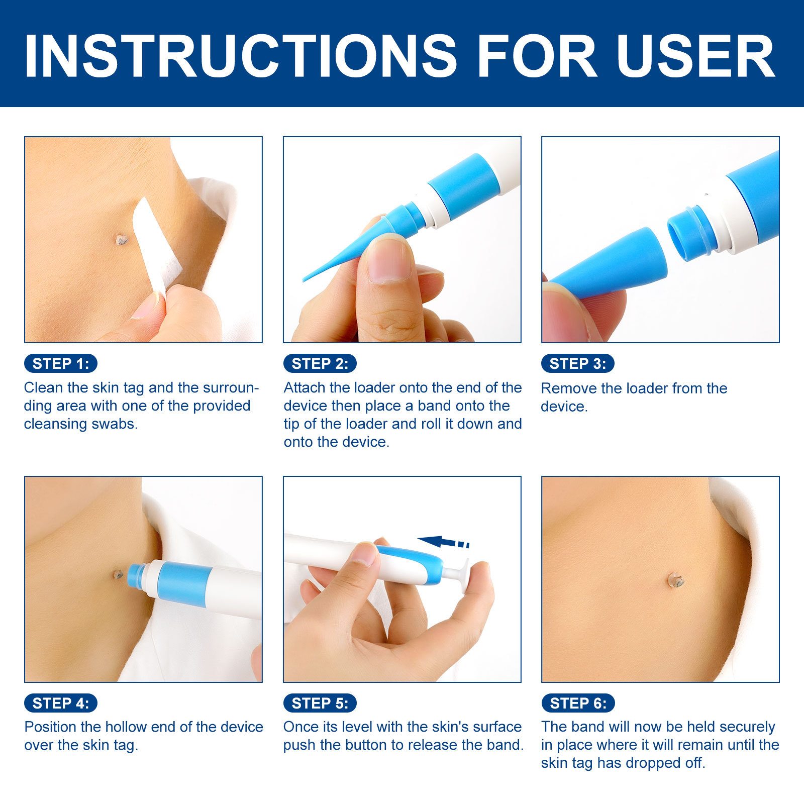 2-IN-1 Auto Skin Tag Removal K - Home Improvement Kit ulasan dan harga
